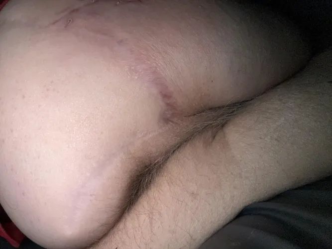 Scar from backside