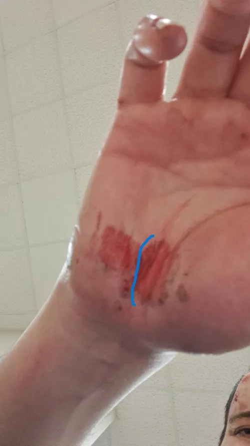 Healing Time for Scooter Injury?