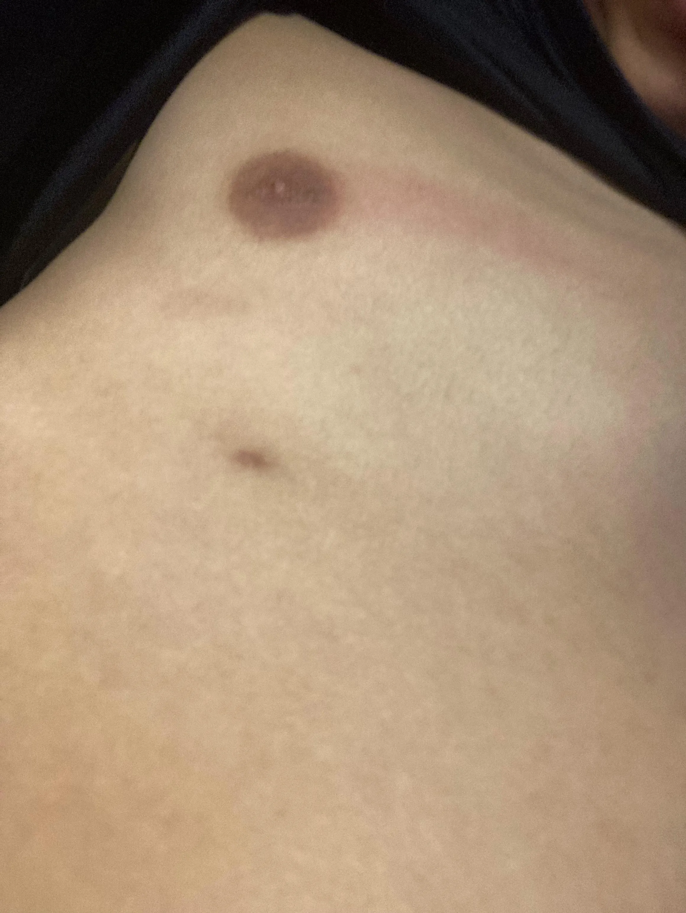 Is this area bad for a bruise