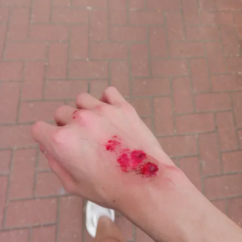 Scraped my hand (someone crashed into me plus he was running super fast)