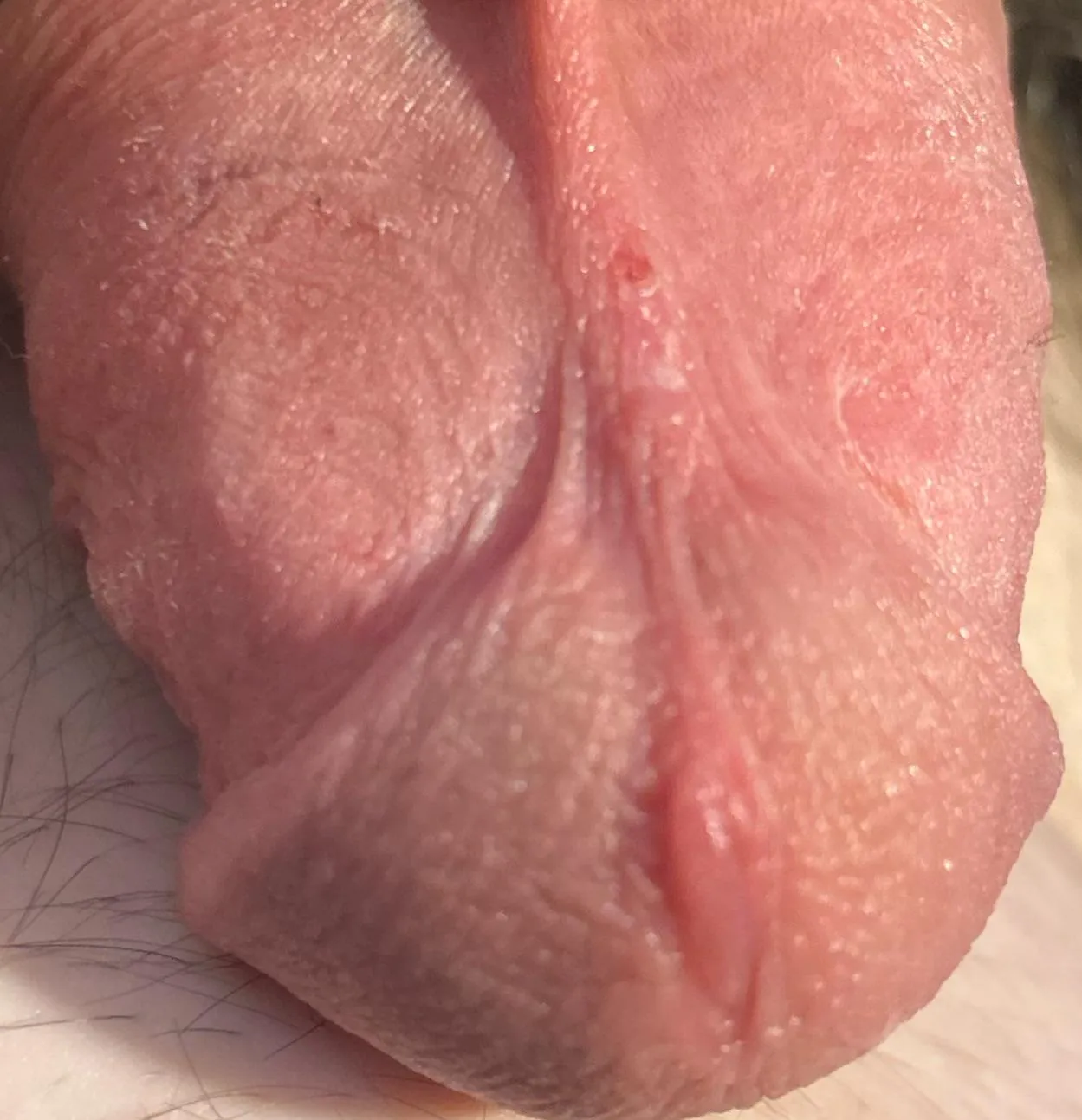 Should I be defrenned?