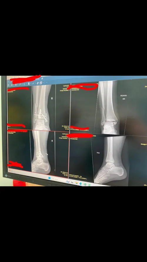 Had surgery on my leg/ankle and don’t think they’ve done it right