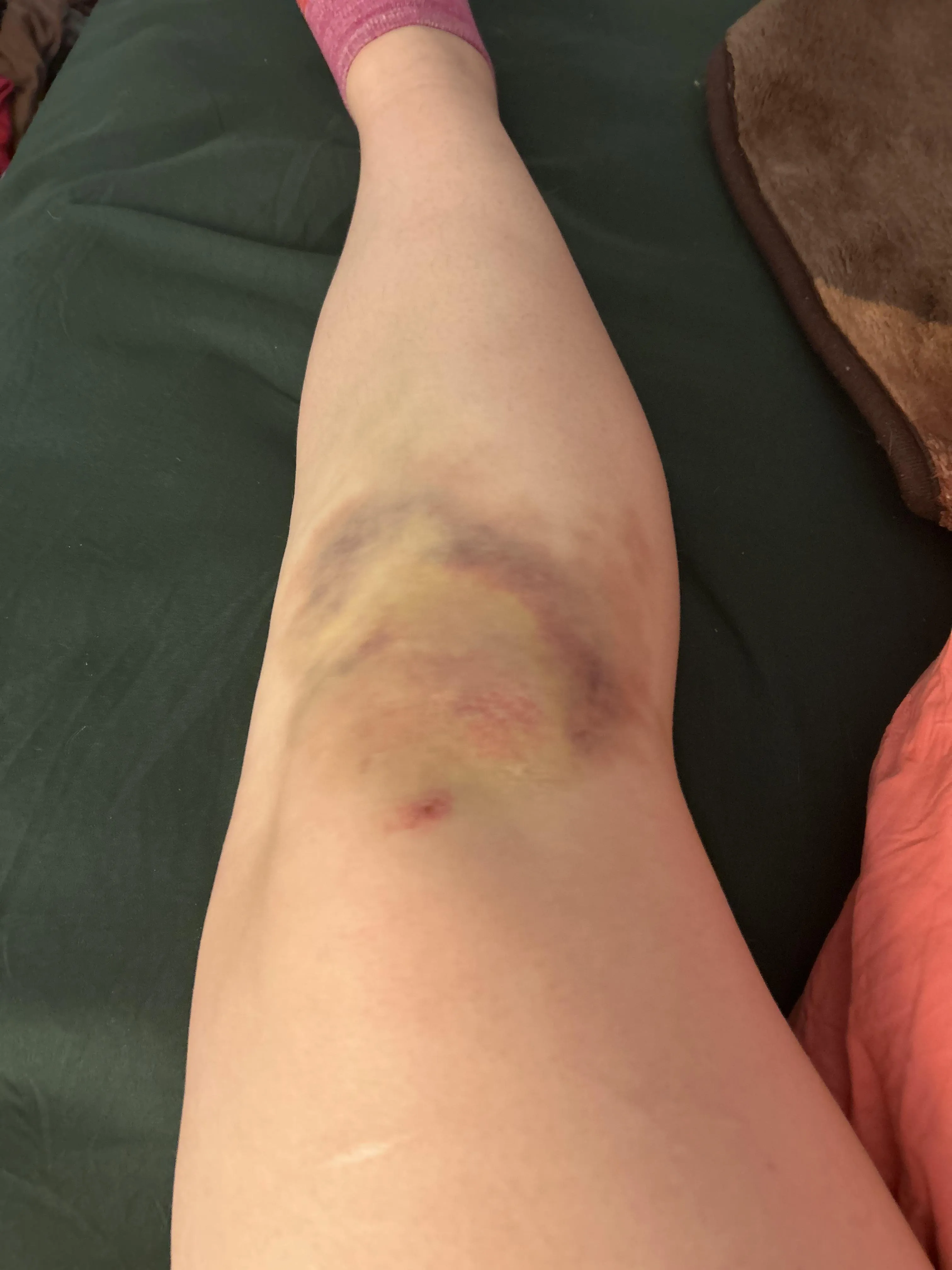 I fell while running to catch the bus