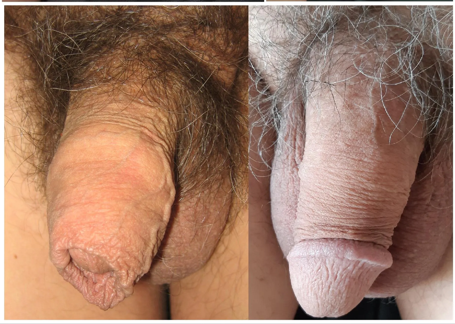 До и после обрезания