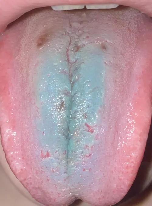 Could these brown spots on my tongue be from sour candy? Or is there something else wrong? Please help me identify.