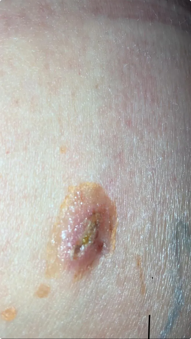 I had a diagnostic laparoscopy & I was curious on if this looks infected or not to anyone
