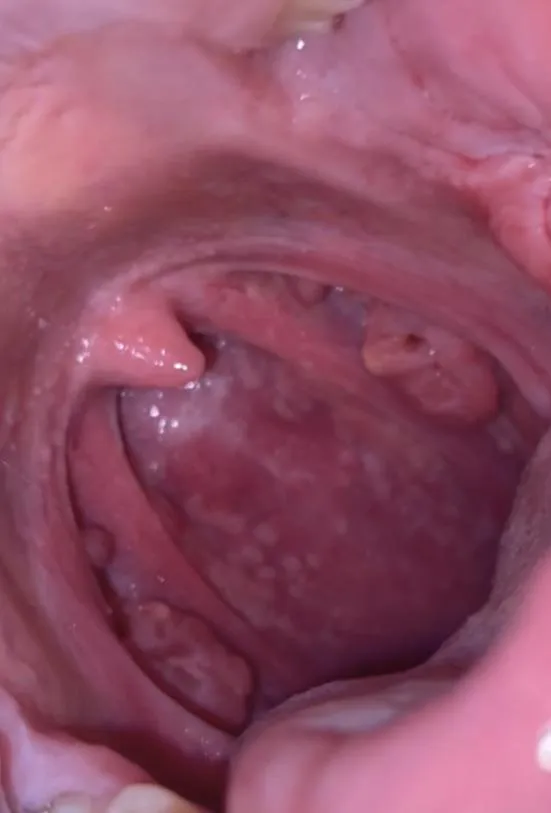 Weeks of throat pain and loss of voice, it started out as a loss of voice 3 weeks ago I got my voice back but the pain has increased