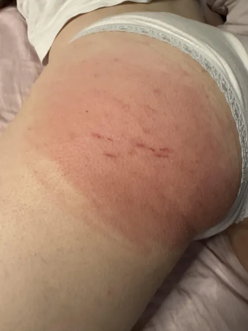Spanked so hard it broke the skin