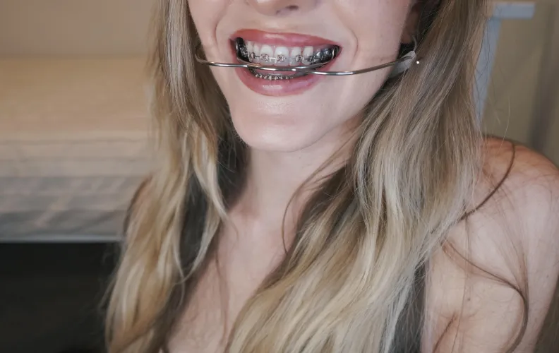 Back with my metal mouth