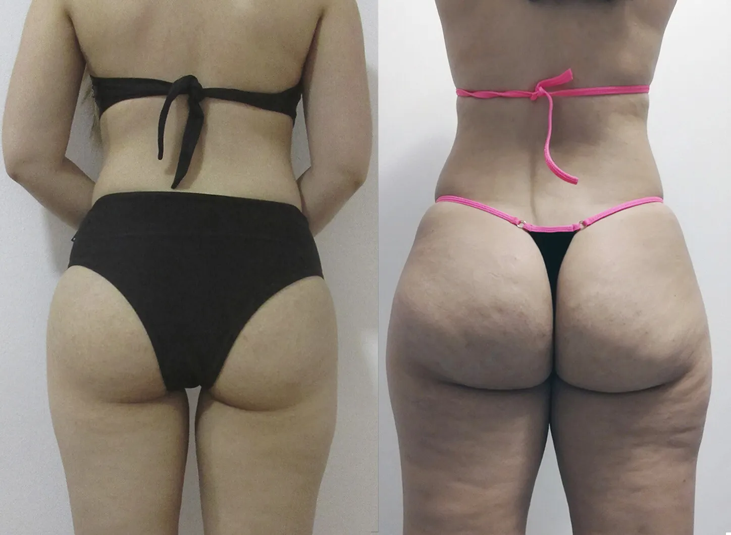 25yo butt vs 37yo butt. Cellulite is the sexiest detail, do you agree?