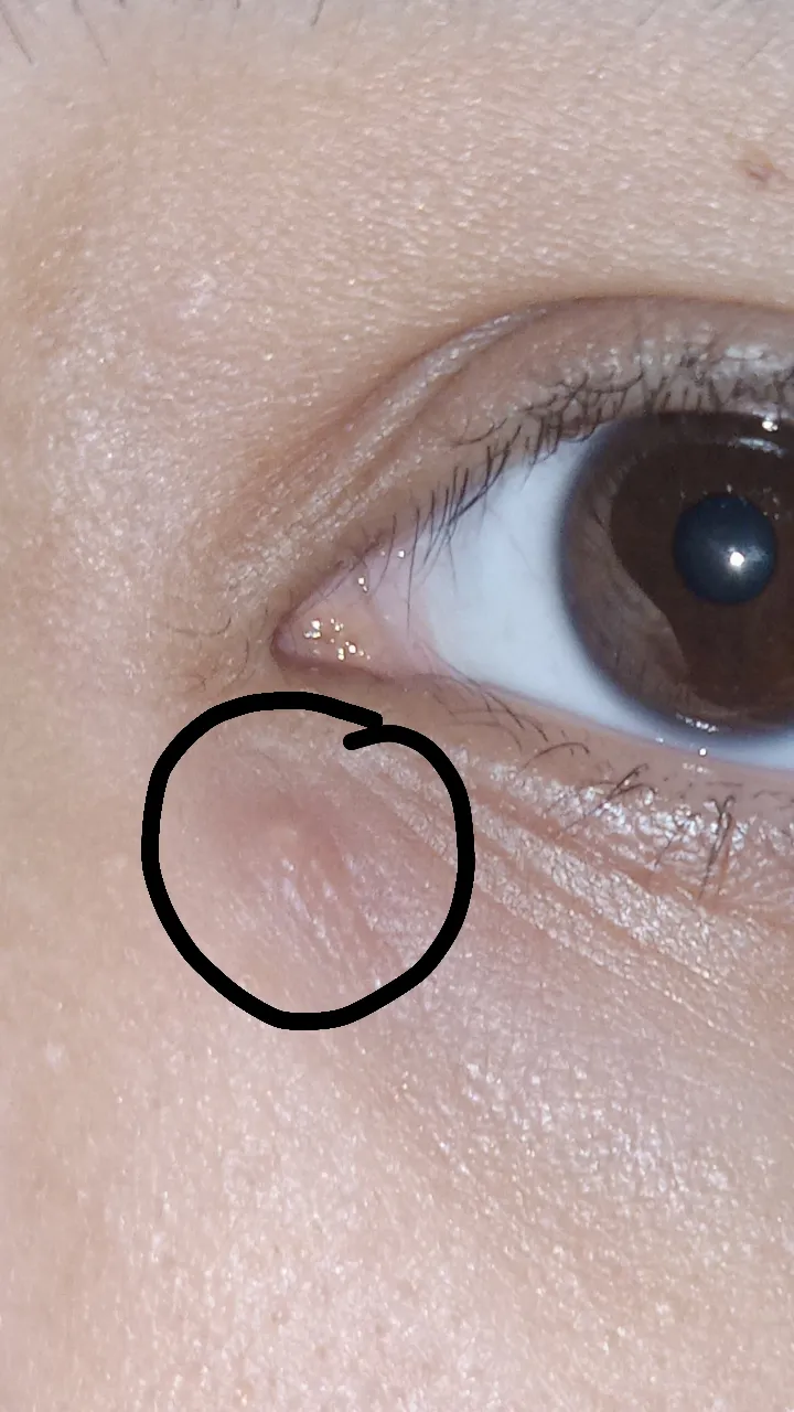 Bumps near my eye