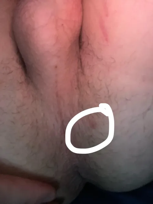 is this a pimple or something else