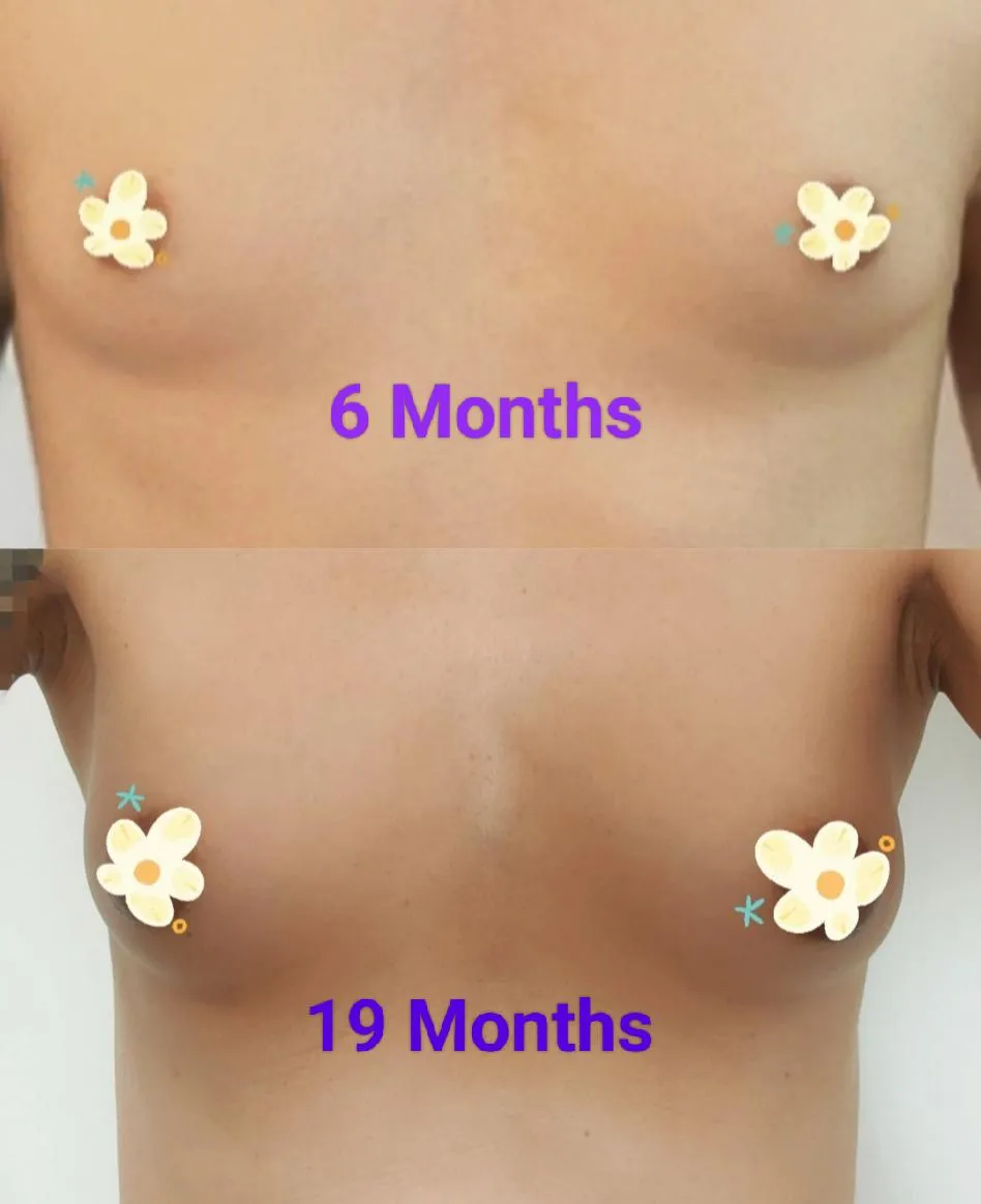 My HRT Journey: 19 Months of Change, Growth & Joy