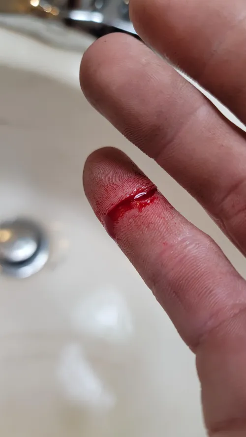 almost got degloved by a metal stud