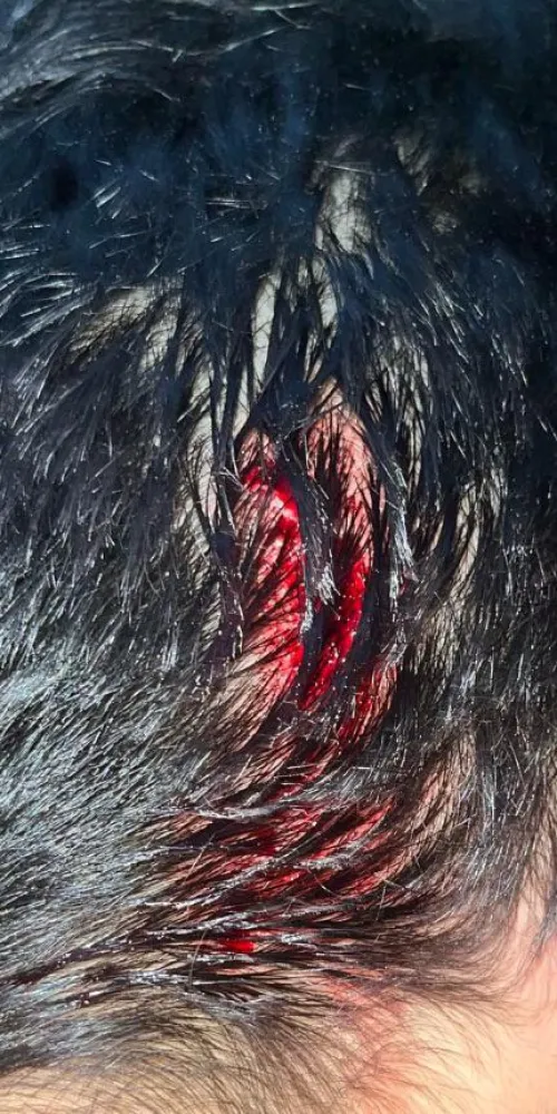 Hit on the head with a rock