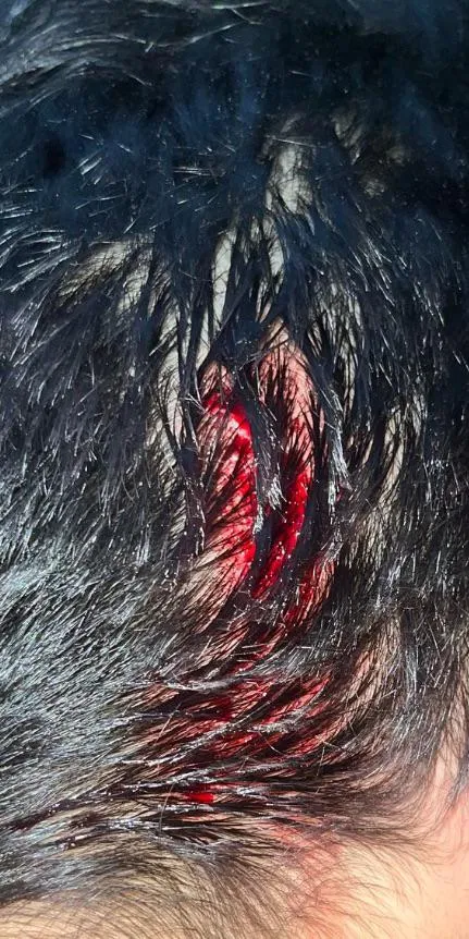 Hit on the head with a rock