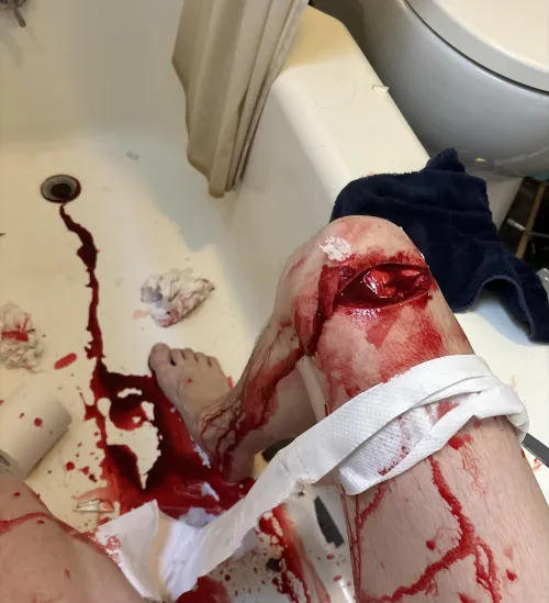 mirror broke in the shower and sliced my knee :0