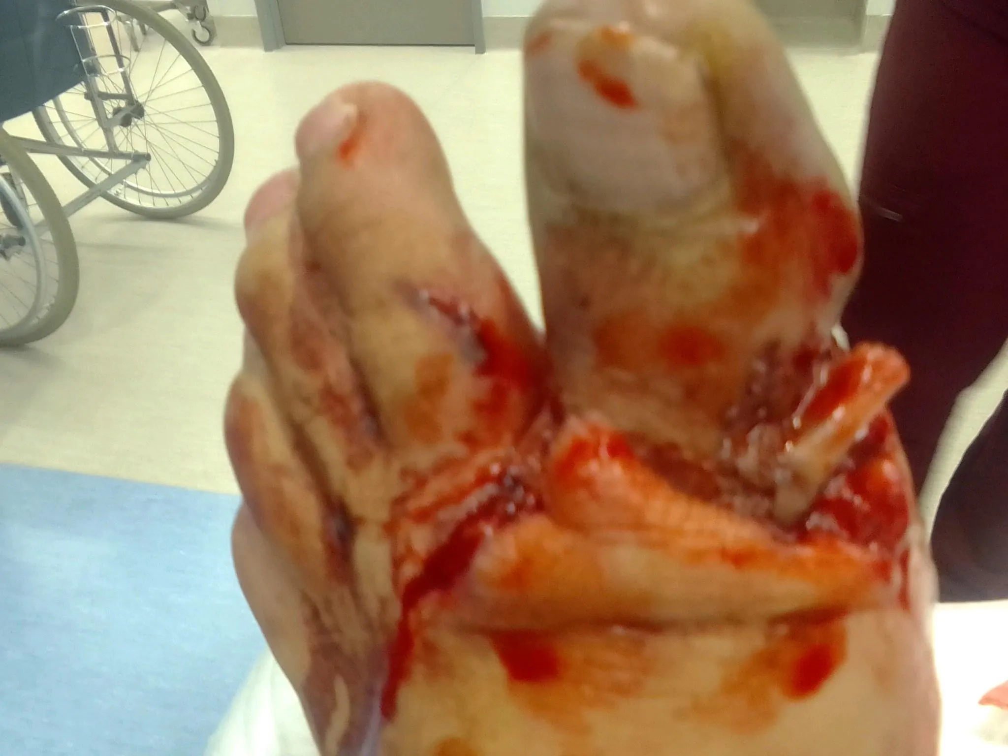 My original toe injury 😞😮‍💨😱