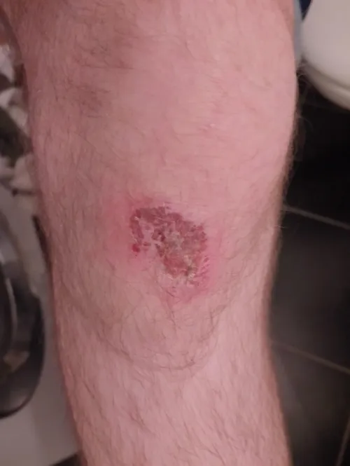 Small knee abrasion