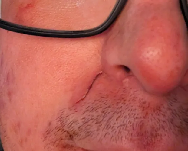 First time using nitrous. Lol.