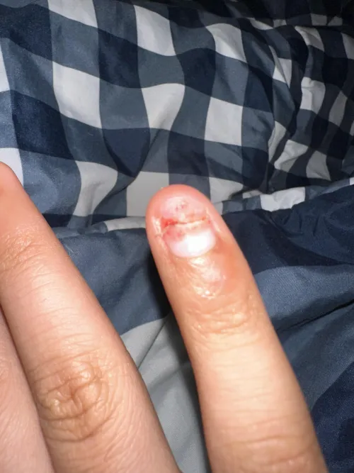 cracked nail fell off, when can i expect a full regrowth?