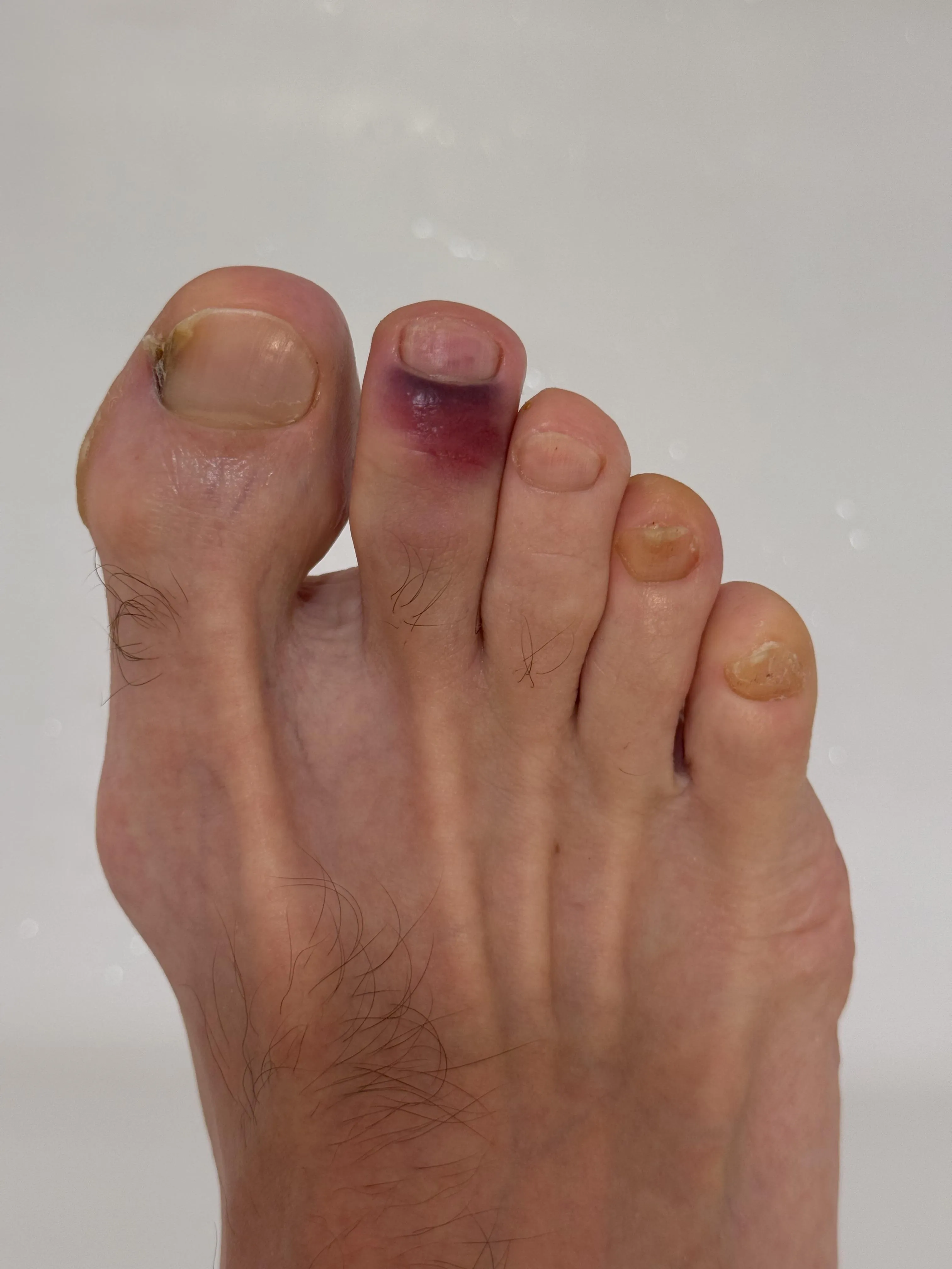 Is my toe broken or just bruised?