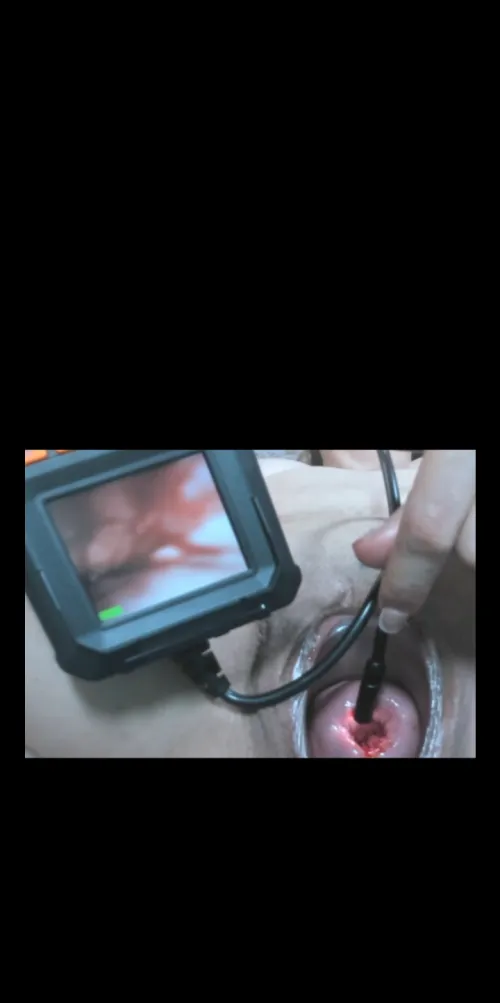 Cervix in HD
