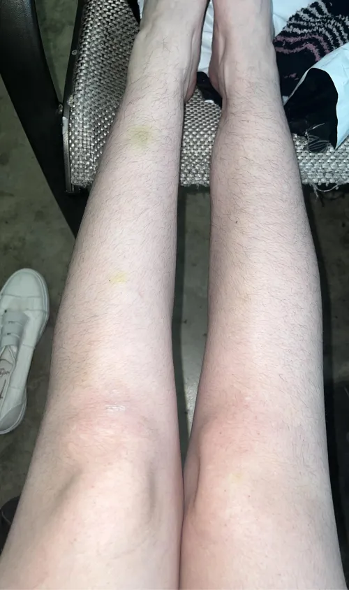 I'm worried people will start to judge me for being so hairy...