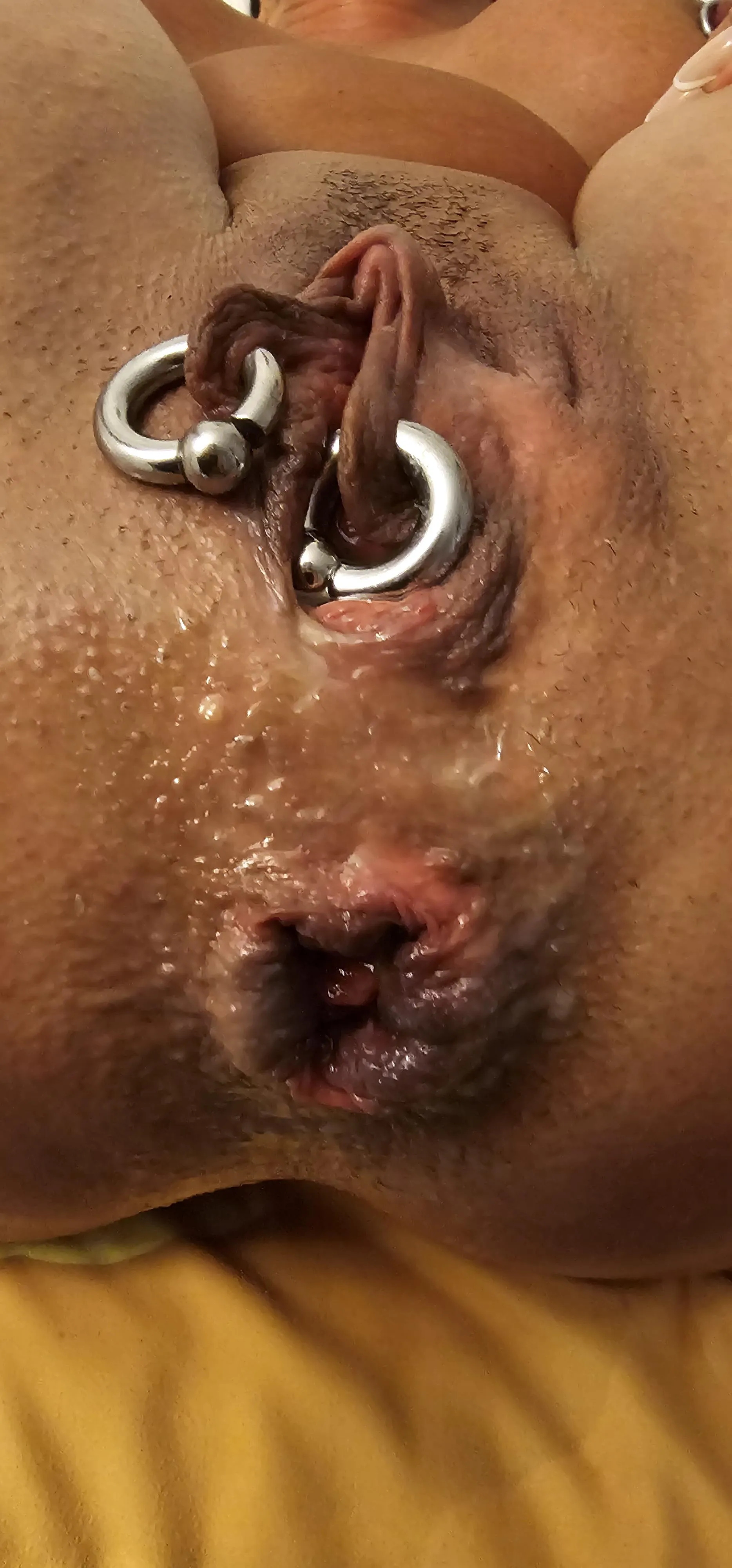 Pierced and prolapsing