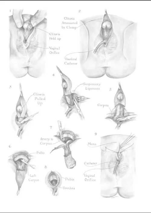 How to circumcise your wife