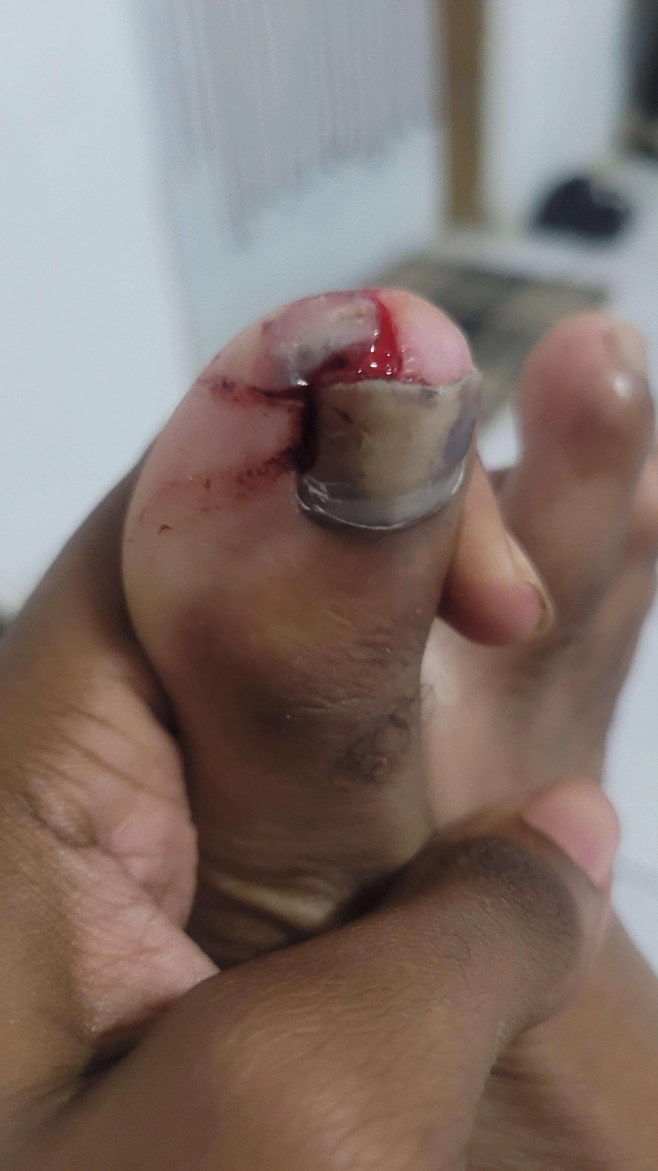 4x4 fell on my foot a couple of months ago. Stubbed my toe yesterday and it resulted in this...should I get it checked out?