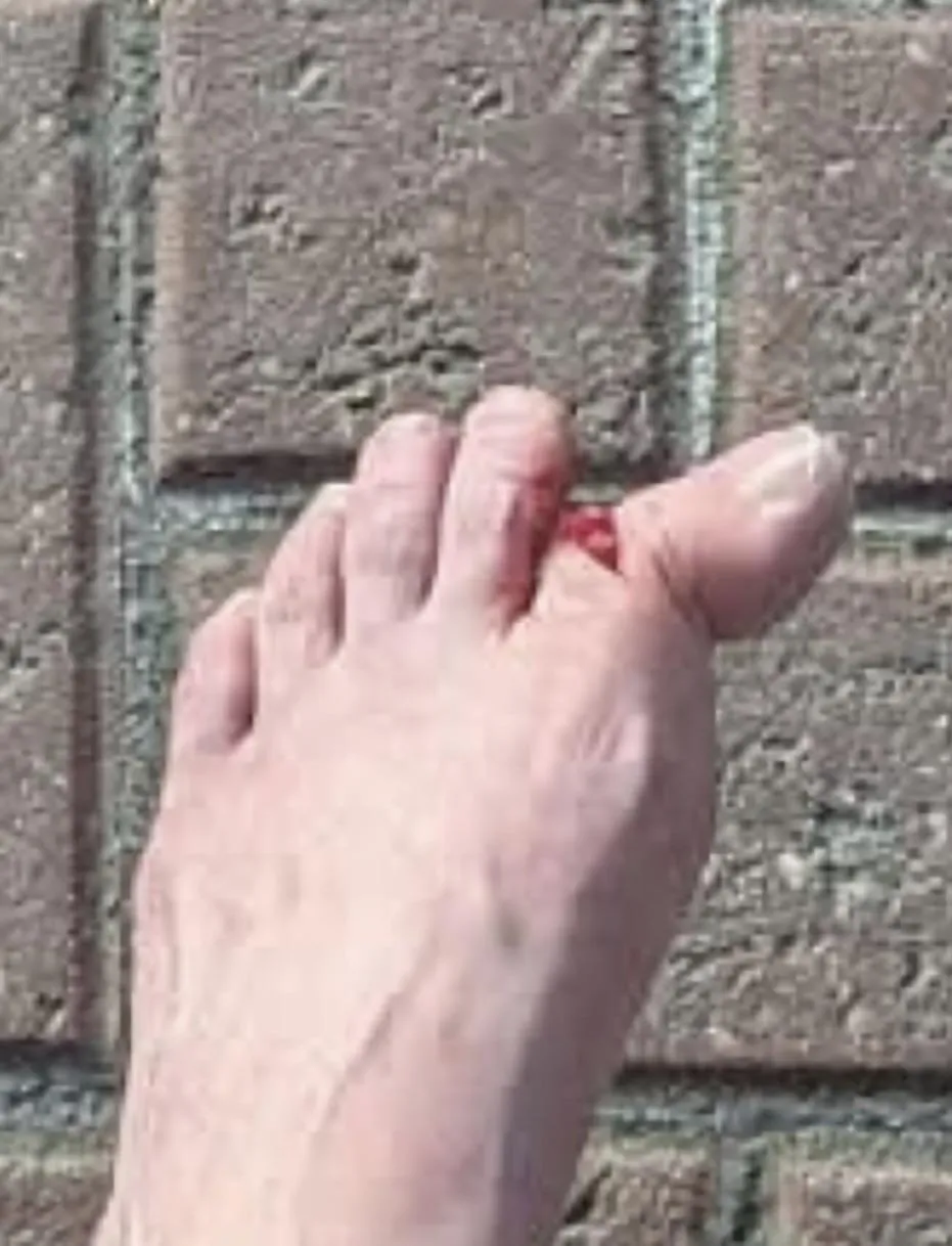 My mom’s cousins after slipping while playing pool.