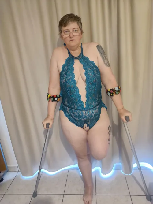 f47 amputee with EDS