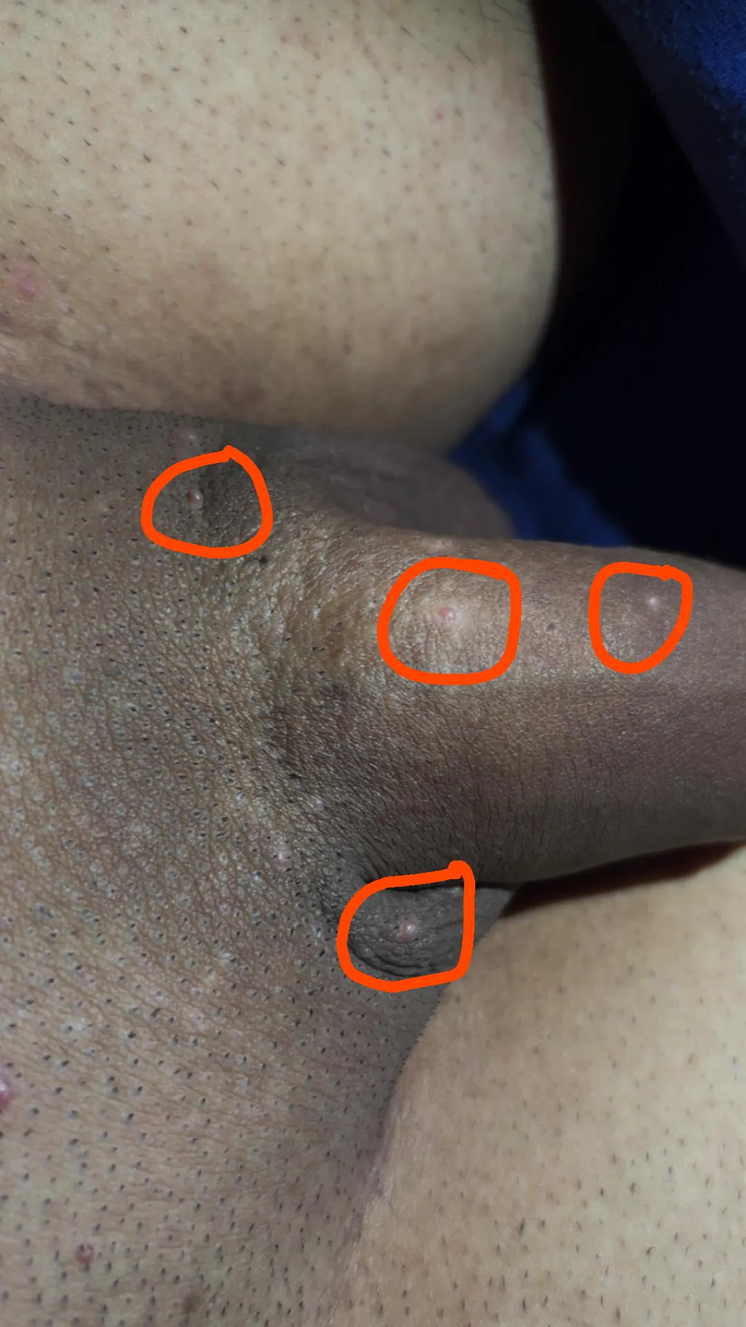 I am 23 years old and I got these white spots and a pimple in the middle. It doesn't hurt or anything and it doesn't cause me any discomfort.