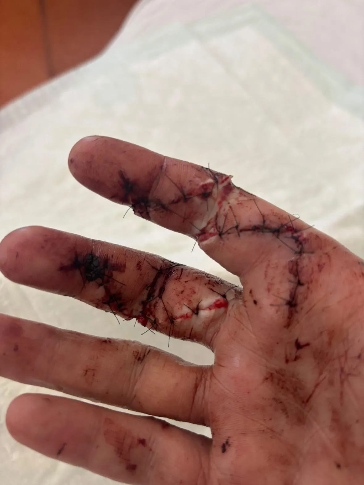 I cut two flexor tendons just because I was drunk