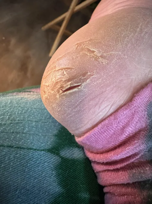 Super deep crack in my heel