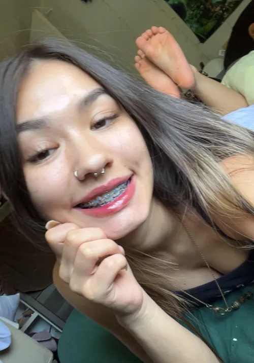 Do you like my braces?