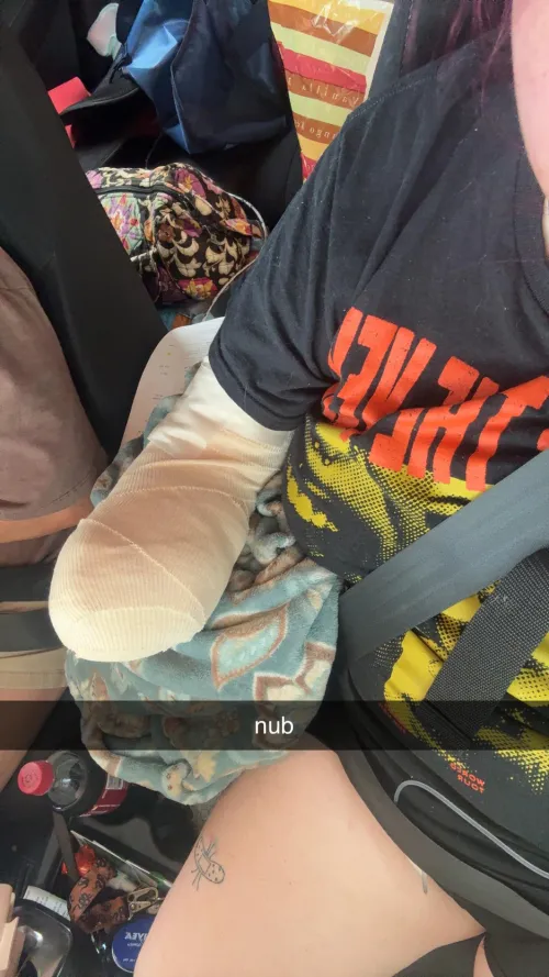 recently had my arm amputated