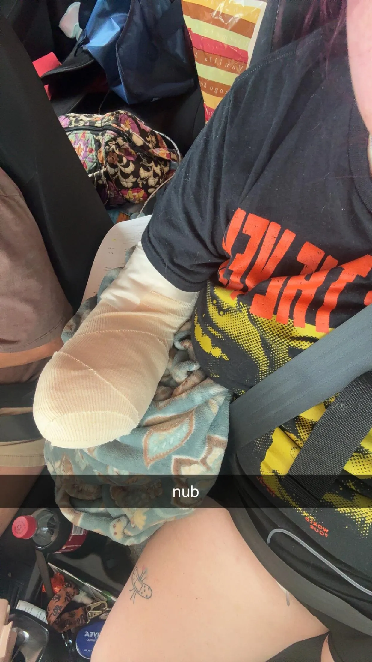 recently had my arm amputated