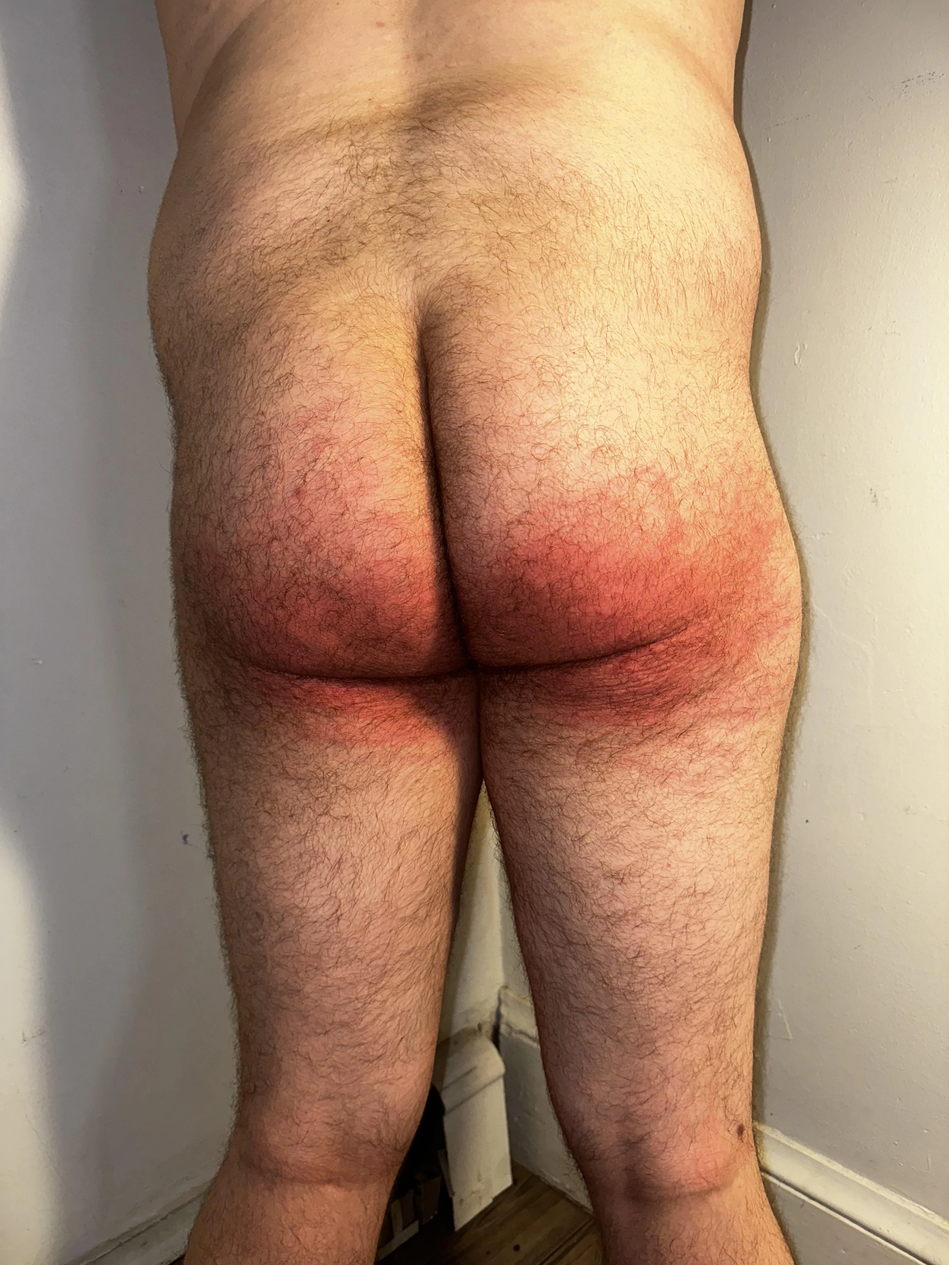Aftermath of my spanking from last night.
