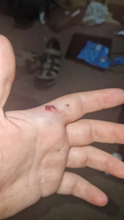 Couple blood blisters and bruises from slingshot shooting 9mm steel ball bearings