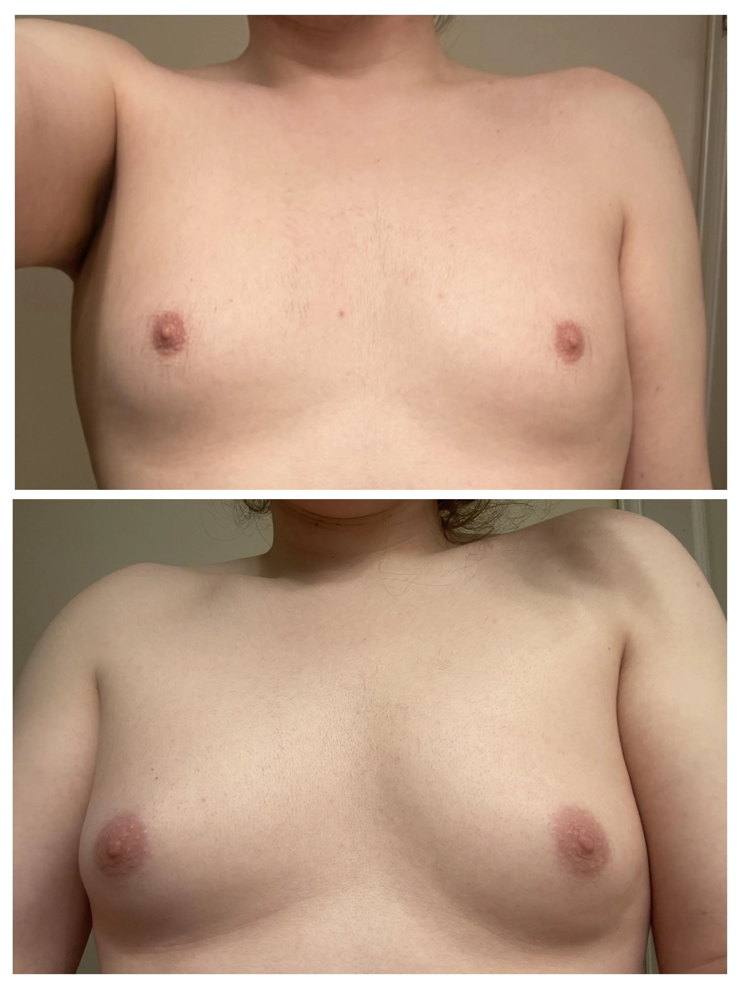 4 months into HRT. 1 month exactly on increased dose. :)