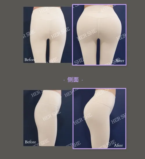 Hip filler (not implants) from the side its okay but from the back….