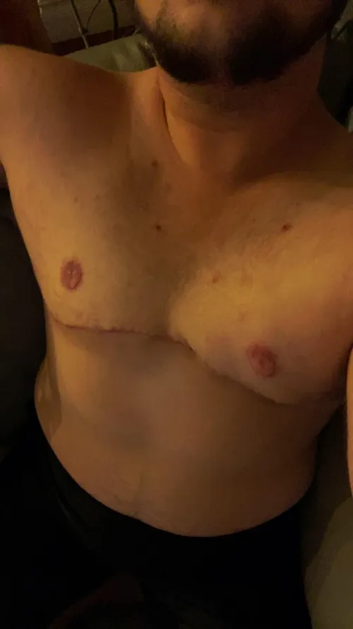 21 One month post op and feeling fucking sexy