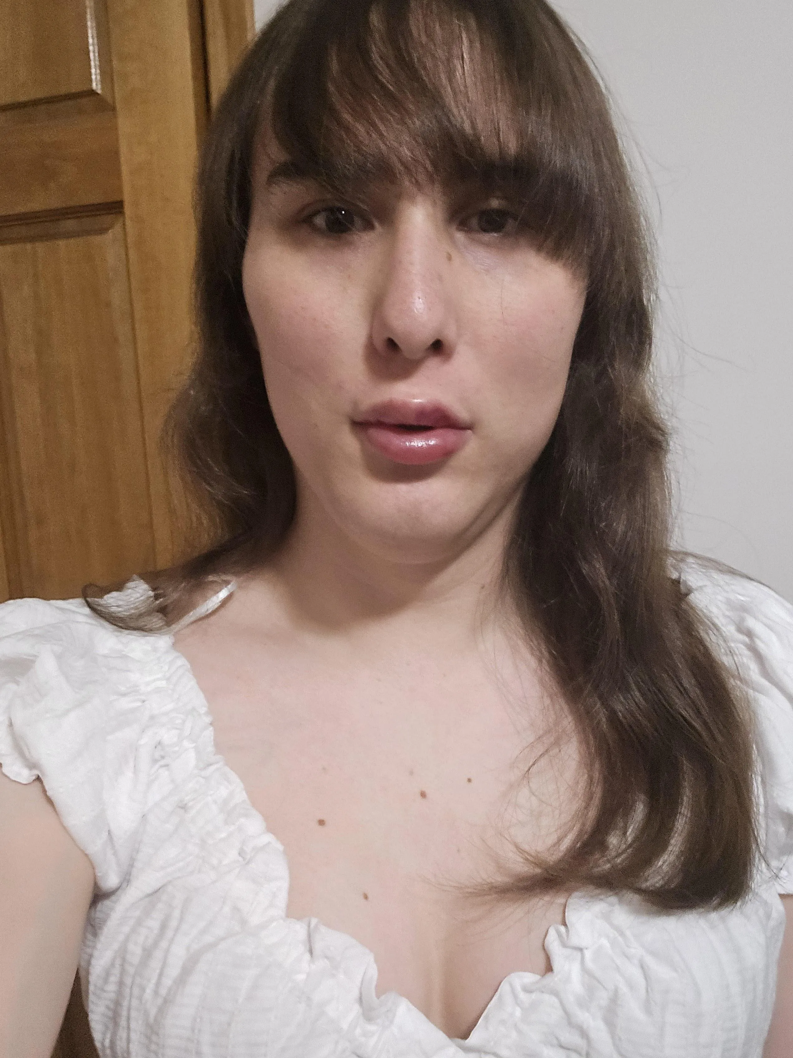 3ml of filler, 2ml of cheek filler. How does it look?