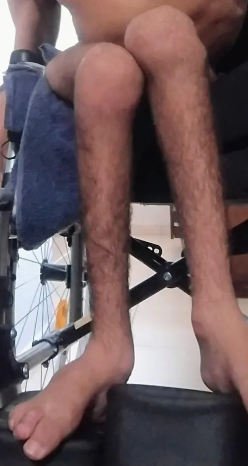 Paraplegic, spina bifada, scoliosis, man 21