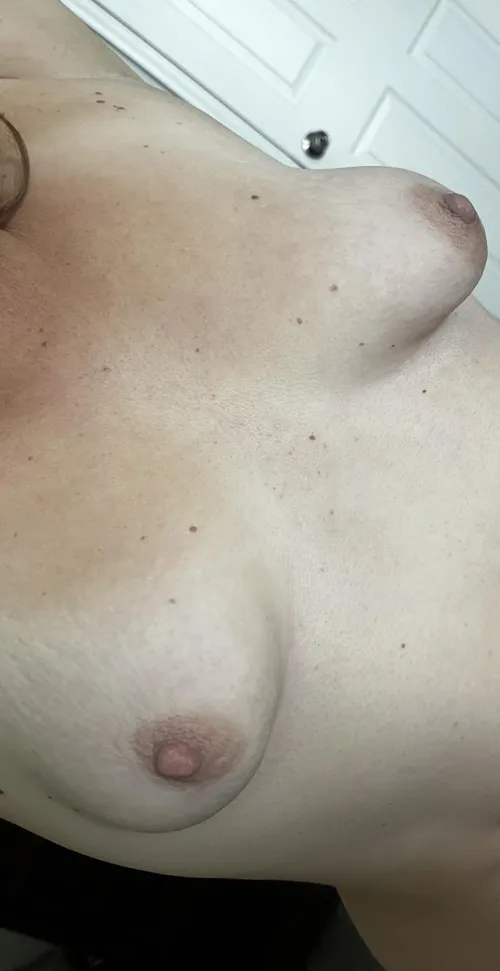 (40F) Tuberous with stretch marks from two kids