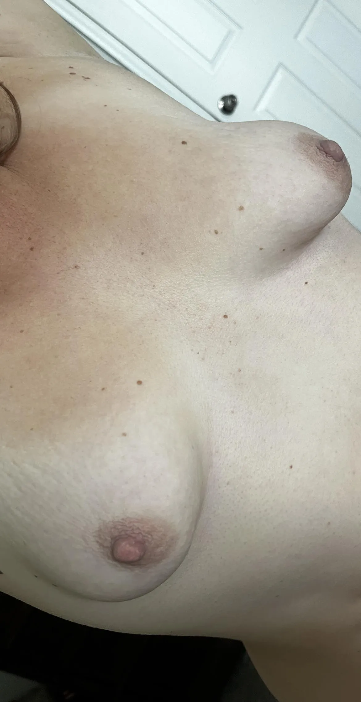 (40F) Tuberous with stretch marks from two kids