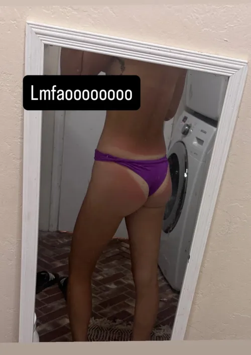 She burnt her butt lol