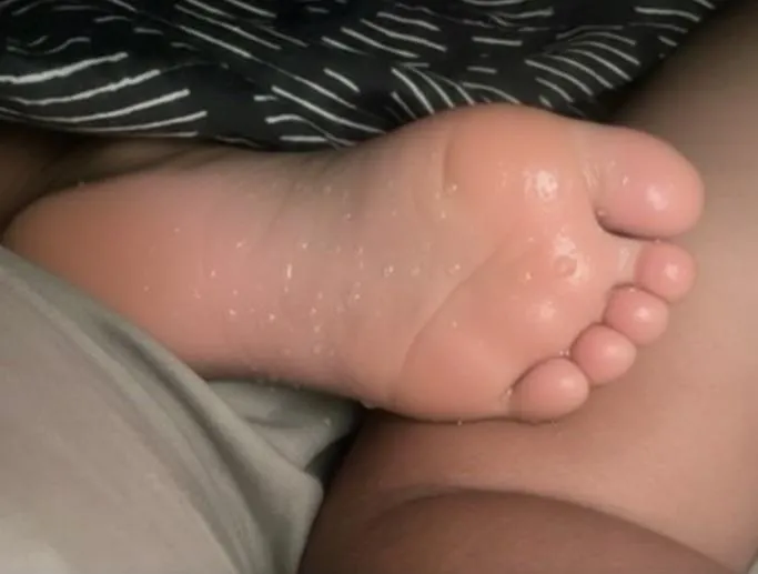 I have the problem of hyperhidrosis! And most of the time my feet look like this!